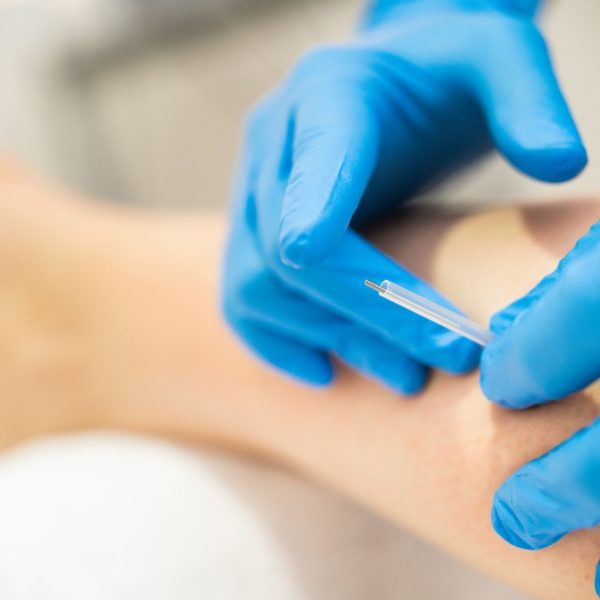 Kurs Suche igłowanie - dry needling - igłoterapia