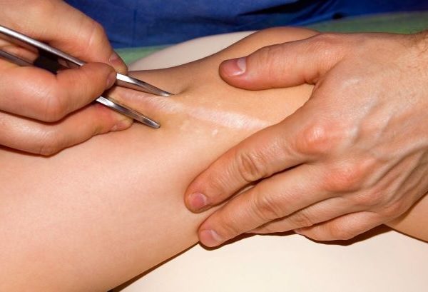 Terapia blizn