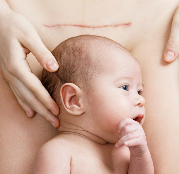 Terapia blizny po cc