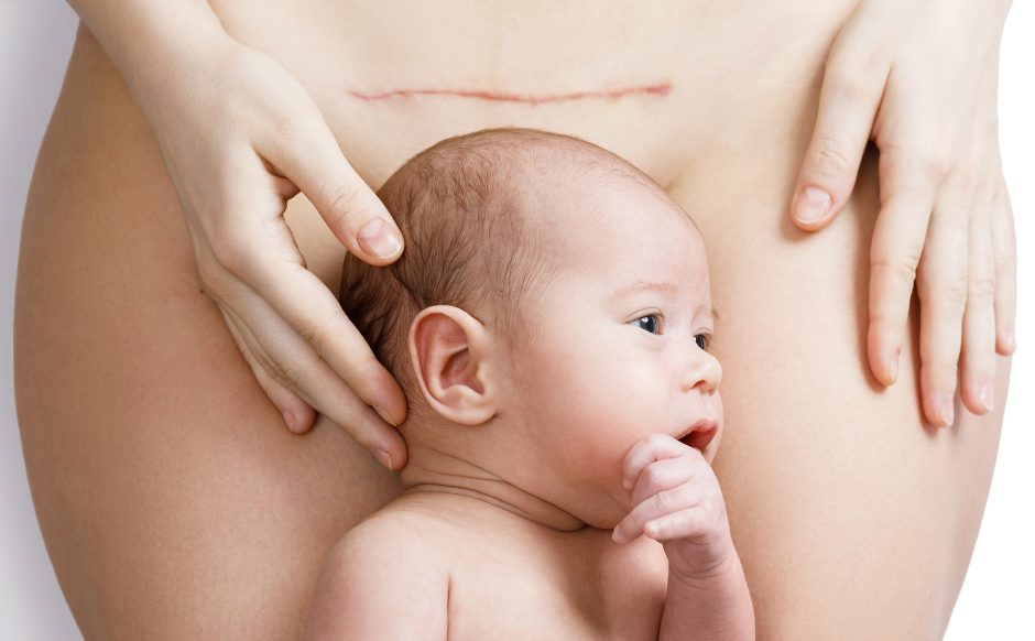 Terapia blizny po cc